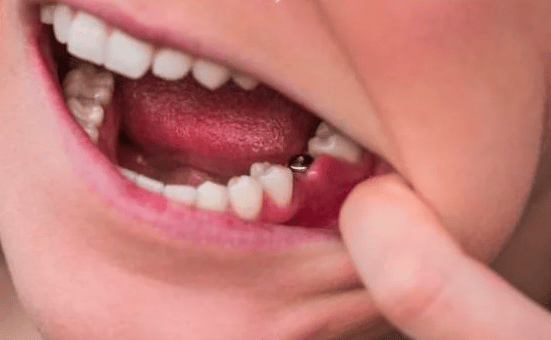 أعراض فشل زراعة الأسنان