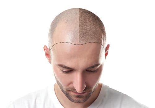 بديل زراعة الشعر