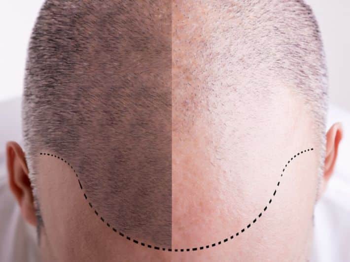 مميزات وعيوب زراعة الشعر
