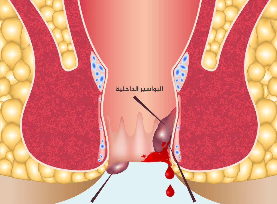 علاج نزيف البواسير المتكررة