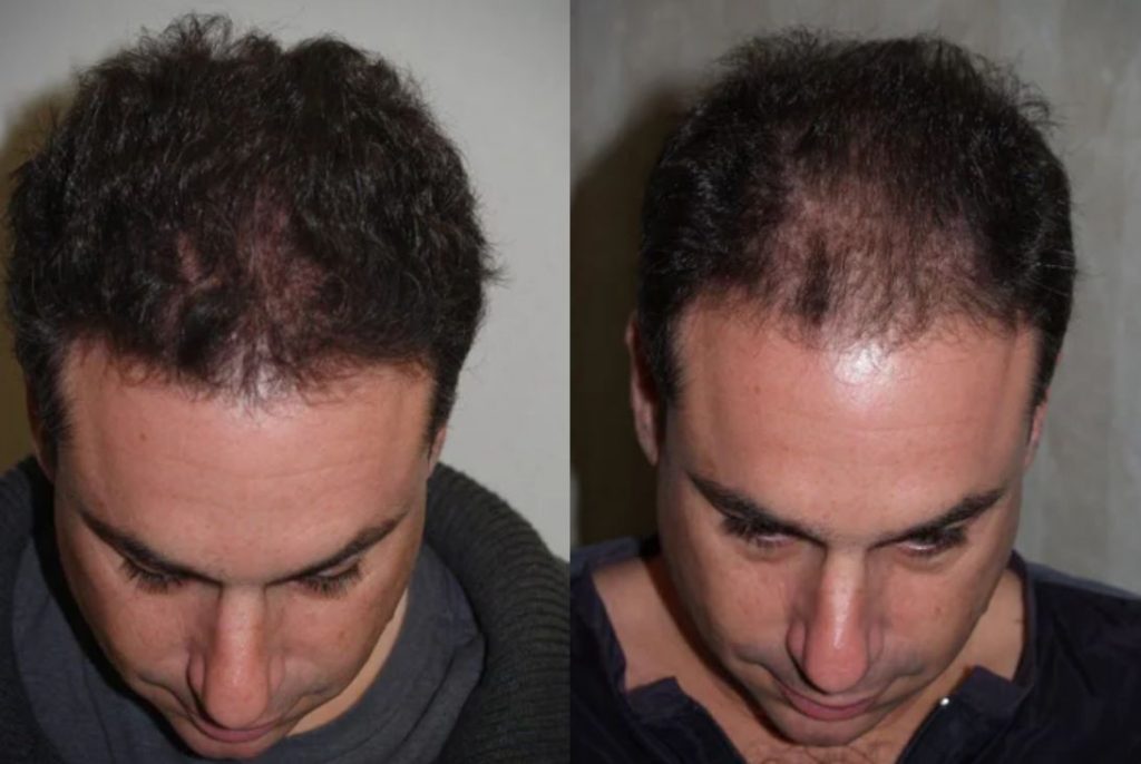تجربتي مع زراعة الشعر