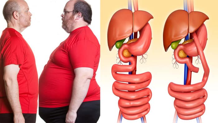 تجربتي مع تحويل مسار المعدة