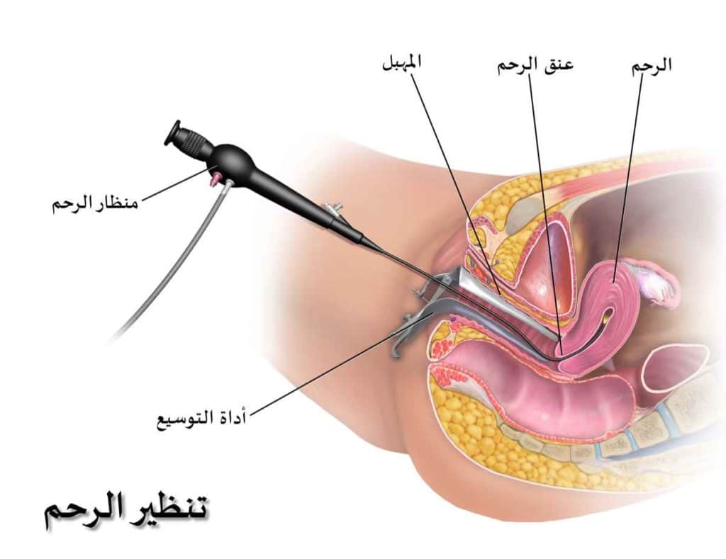أفضل وقت لعمل منظار الرحم
