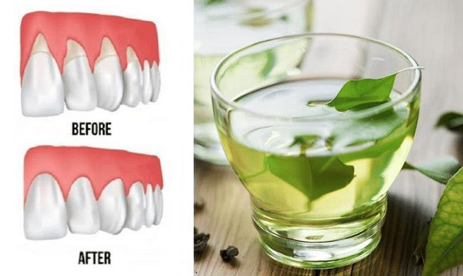 علاج نزيف اللثة بالاعشاب