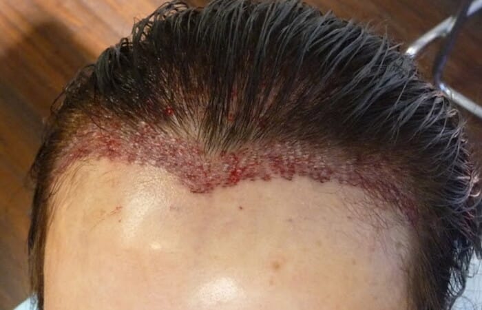 هل زراعة الشعر دائمة