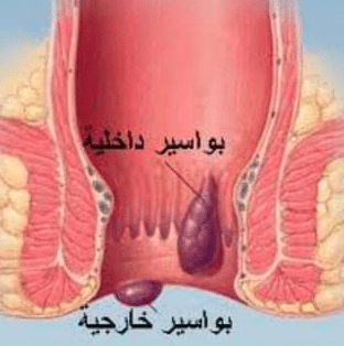 تجربتي مع البواسير الداخلية