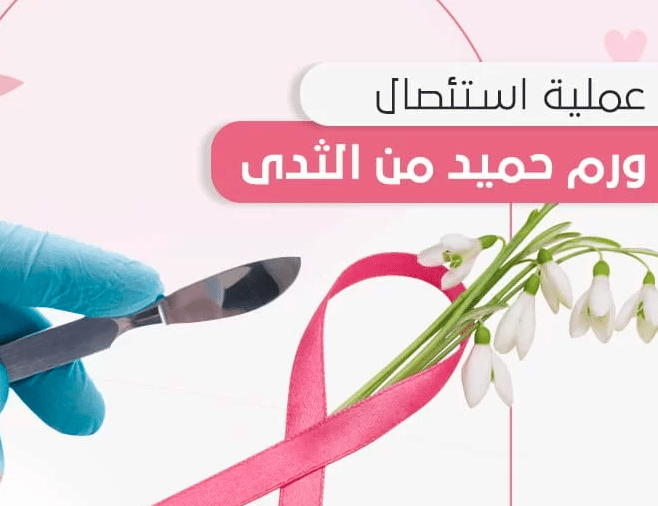 استئصال ورم الثدي الحميد