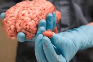 تجربتي مع نزيف الدماغ