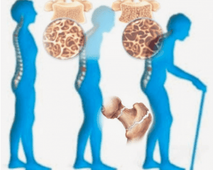 تجربتي مع هشاشة العظام