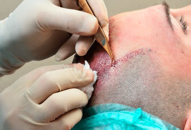 هل زراعة الشعر تسبب السرطان