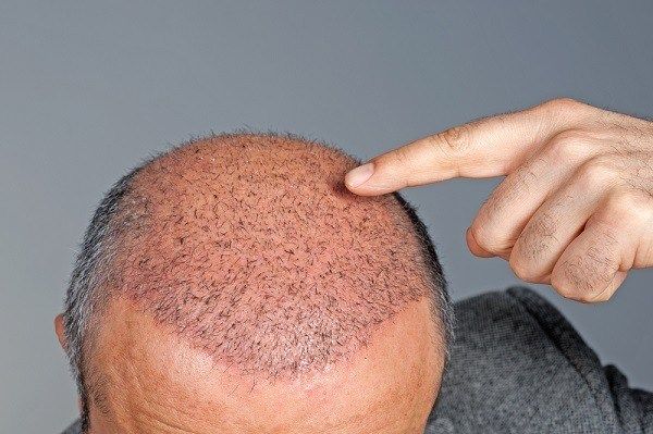 تكلفة زراعة الشعر