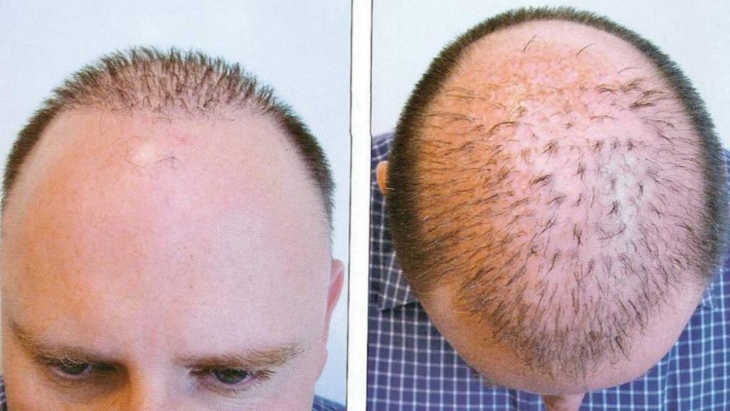 هل زراعة الشعر حرام