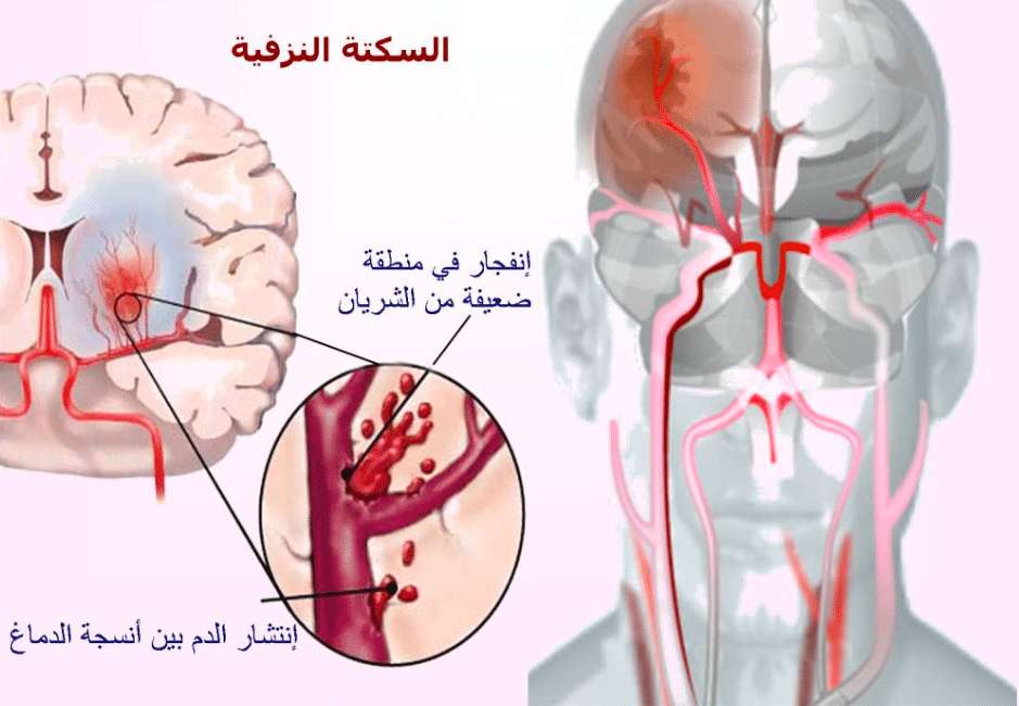 قصتي مع نزيف الدماغ
