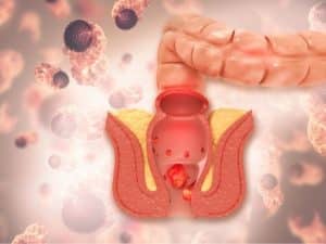 علاج البواسير الداخلية في المنزل