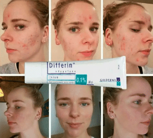 كيفية استخدام differin