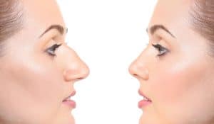 معلومات عن عملية تجميل الانف