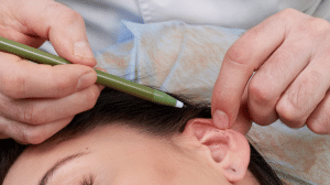 معلومات عن عملية تجميل الاذن