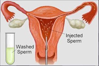 IUI