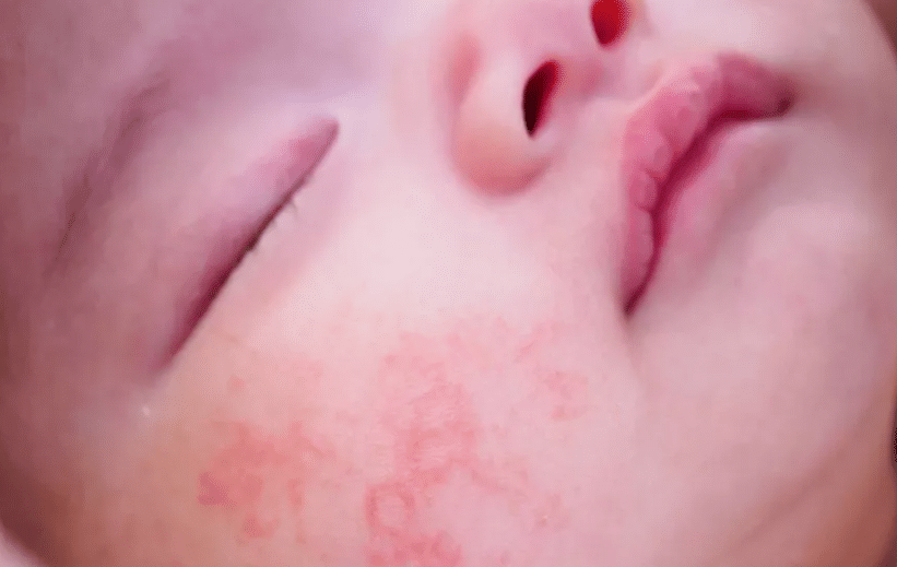 تجربتي مع علاج حساسية الوجه