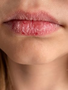 أسباب تشقق الشفاه