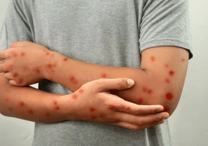 تعبير حول مرض الحصبة بالانجليزي مترجم